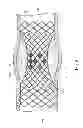 Fig. 09 - Gradually self-expanding stent