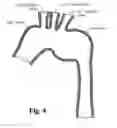 Fig. 05 - Modular stent grafting methods and apparatus