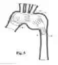 Fig. 06 - Modular stent grafting methods and apparatus