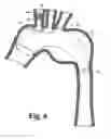 Fig. 07 - Modular stent grafting methods and apparatus