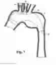 Fig. 08 - Modular stent grafting methods and apparatus