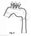 Fig. 09 - Modular stent grafting methods and apparatus
