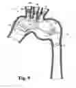Fig. 10 - Modular stent grafting methods and apparatus