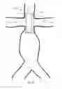 Fig. 16 - Modular stent grafting methods and apparatus