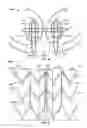 Fig. 34 - Stent features for collapsible prosthetic heart valves