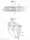 Fig. 02 - Alignment Device for Asymmetric Transcatheter Valve