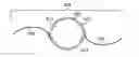 Fig. 01 - Method for Creating Incision to Improve Intraocular Lens Placement