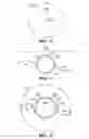 Fig. 07 - Method for Creating Incision to Improve Intraocular Lens Placement