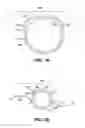 Fig. 10 - Method for Creating Incision to Improve Intraocular Lens Placement