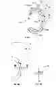 Fig. 05 - Method and implant for replacing damaged meniscal tissue
