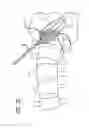 Fig. 08 - Minimally invasive method and surgical tools for trans-PSOAS approach