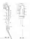 Fig. 02 - Prosthetic having a modular soft tissue fixation mechanism