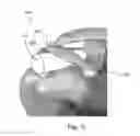 Fig. 03 - Shoulder implant for simulating a bursa