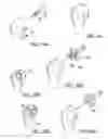Fig. 09 - Modular humeral head resurfacing system