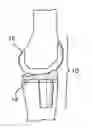 Fig. 01 - Systems and methods for providing a modular femoral component