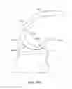 Fig. 37 - Systems and methods for providing a modular femoral component