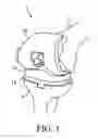 Fig. 02 - KNEE ARTHROPLASTY TIBIA COMPONENT AND KNEE ARTHROPLASTY