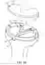Fig. 06 - KNEE ARTHROPLASTY TIBIA COMPONENT AND KNEE ARTHROPLASTY