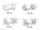 Fig. 05 - Hip and knee joint assemblies incorporating debris collection architecture between the ball and seat interface