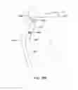 Fig. 72 - Systems and methods for providing an asymmetrical tibial component