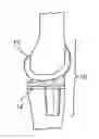 Fig. 01 - Systems and methods for providing a femoral component with a modified posterior condyle