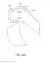 Fig. 23 - Systems and methods for providing a femoral component with a modified posterior condyle