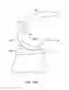 Fig. 37 - Systems and methods for providing a femoral component with a modified posterior condyle