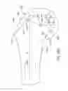 Fig. 76 - Systems and methods for providing a femoral component with a modified posterior condyle
