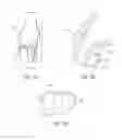 Fig. 03 - Systems and methods for providing an asymmetrical femoral component