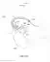 Fig. 68 - Systems and methods for providing an asymmetrical femoral component