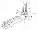 Fig. 01 - Ankle replacement system