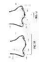 Fig. 15 - Cannula for minimizing dilution of dosing during nitric oxide delivery