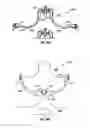 Fig. 25 - Expandable device for use in a well bore