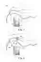 Fig. 07 - Endoscopic registration of vessel tree images