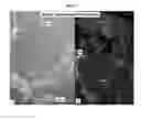 Fig. 09 - Method of treating pancreatic and liver conditions by endoscopic-mediated (or laparoscopic-mediated) transplantation of stem cells into/onto bile duct walls of particular regions of the biliary tree