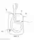 Fig. 03 - SYSTEMS, DEVICES, AND METHODS FOR EMBEDDING DRUG MOLECULES INTO MEDICAL CATHETERS OR TUBES