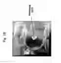 Fig. 03 - Double-structured tissue implant and a method for preparation and use thereof