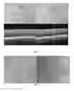 Fig. 04 - METHODS OF DIAGNOSING AND TREATING VASCULAR ASSOCIATED MACULOPATHY AND SYMPTOMS THEREOF