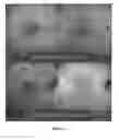 Fig. 06 - METHODS OF DIAGNOSING AND TREATING VASCULAR ASSOCIATED MACULOPATHY AND SYMPTOMS THEREOF