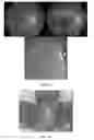 Fig. 09 - METHODS OF DIAGNOSING AND TREATING VASCULAR ASSOCIATED MACULOPATHY AND SYMPTOMS THEREOF