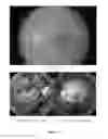 Fig. 02 - METHODS, APPARATUS, AND COMPOUNDS FOR THE TREATMENT OF CENTRAL RETINAL VEIN OCCLUSION AND OTHER CONDITIONS