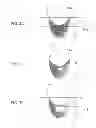 Fig. 04 - Device to Aid in Diagnosing Infiltration or Extravasation in Animalia Tissue