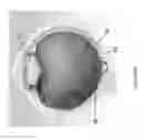 Fig. 56 - IMPLANTS WITH CONTROLLED DRUG DELIVERY FEATURES AND METHODS OF USING SAME