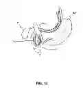 Fig. 11 - Positioning system for manipulating a channel within a medical device