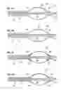 Fig. 04 - Apparatus and methods for treating obstructions within body lumens