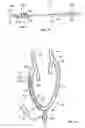Fig. 10 - Apparatus and methods for treating obstructions within body lumens