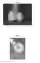 Fig. 02 - Delivery of materials into margins of tissue cavities