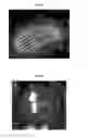 Fig. 04 - Delivery of materials into margins of tissue cavities