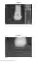 Fig. 06 - Delivery of materials into margins of tissue cavities