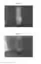 Fig. 07 - Delivery of materials into margins of tissue cavities